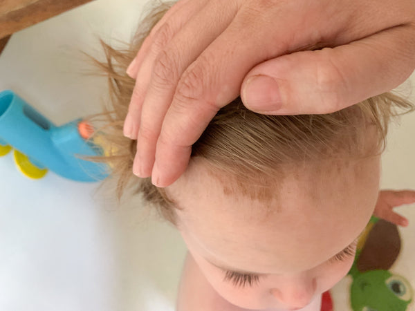 Cradle Cap oil